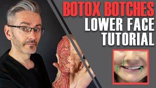 ADVANCED BOTOX ANATOMY: How to avoid nasty lower-face side effects [Aesthetics Mastery Show]