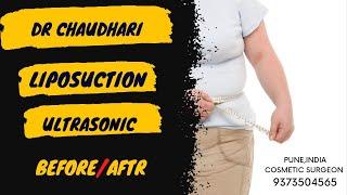 #LIPOSUCTION Abdomen##Liposuction in Pune# #body reshaping#