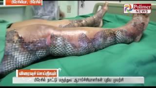 Brazil  uses fish skin to treat skin scars ! | Polimer News | #FishSkinTreatment #Brazil