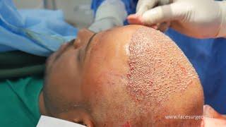 Hair Transplant Surgery In India - Step by Step FUE Hair Transplant Surgery in India - 4000 Grafts