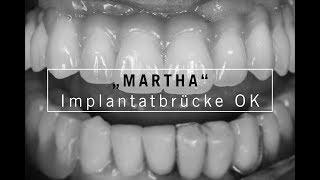 MARTHA - Implantatbrücke