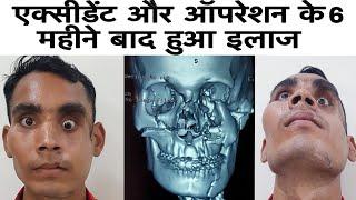 Face Makeover After 6 Months of Accident & 1st Surgery