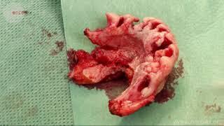 Mandibulectomy