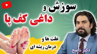 داغی کف پا از چیست | درمان داغی کف پا و سوزش کف پا در خانه با دکتر ناصح