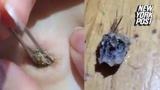 Girl removes gigantic, hairy blackhead from her belly button