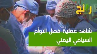 مباشر من غرفة العمليات.. كاميرا ⁧‫الإخبارية‬⁩ تشهد عملية فصل التوأم السيامي اليمني