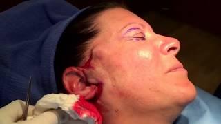Mini Face Lift Surgery -- Short Scars -- No Anesthesia --  Dr Phillip Chang M.D. www.gotobeauty.com