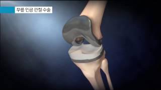퇴행성 무릎관절염 - 무릎 인공 관절 수술