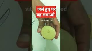 जले हुए पर instant relief  #shorts