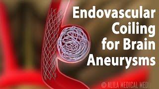 Endovascular Coiling for Brain Aneurysm, Animation.