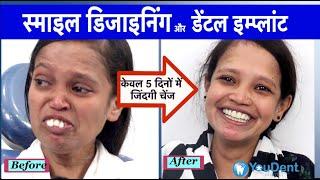 Smile designing treatment in india | Best smile designing treatment | Best dentist for smilemakeover