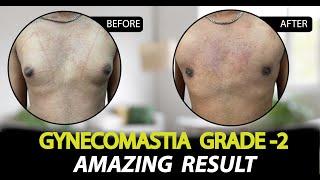 Gynecomastia Surgery in Jaipur | Patient Feedback & Result | Rejuvena Cosmo Care by Dr Deepesh Goyal