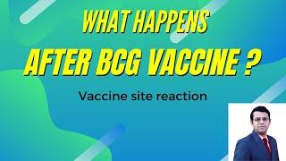 What happens after the BCG vaccine? | Vaccine Site Reaction