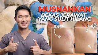 TREATMENT AMPUH UNTUK TIPE JERAWAT ICE PICK SCAR & BEKAS JERAWAT YANG SULIT HILANG!