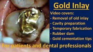 Gold Inlay On Upper Second Molar (Full Procedure And Commentary) | Indirect Case #2