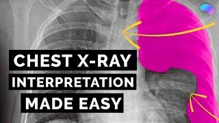 Chest X-ray Interpretation | How to Read a CXR | OSCE Guide | UKMLA | CPSA | PLAB 2