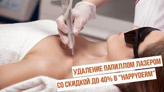 Удаление папиллом лазером со скидкой до 40% в "HappyDerm"