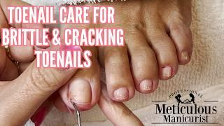 Toenail Repair & Fungus Removal | Restoring Brittle, Painful Toenails Step-by-Step