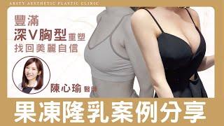 搶救產後胸部變形下垂，E罩杯美麗辣媽隆乳日記｜#產後隆乳 #陳心瑜醫師