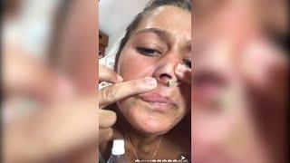 Popping huge blackheads and Giant Pimples - Best Pimple Popping Videos #128