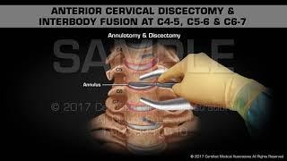 Anterior Cervical Discectomy & Interbody Fusion at C4-5, C5-6 & C6-7