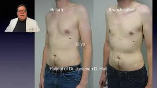 Gynecomastia Procedure with Dr. Jonathan Hall