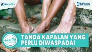 Telapak Kaki Keras Bisa Jadi Kapalan, Kenali Tanda yang Perlu Diwaspadai & Cara Obati secara Medis