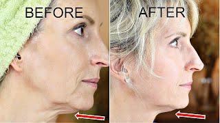 Skin Tightening Anti Aging Device Review | EvenSkyn LUMO | Before & After