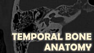 Anatomy of the Temporal Bone on Imaging