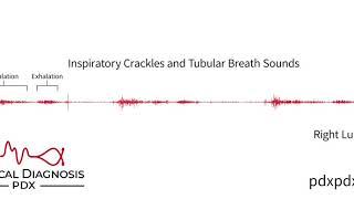 The Lung Sounds of Pneumonia