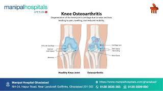 Joint Pain in Winters | Dr. Ashutosh Jha | Manipal Hospital Ghaziabad