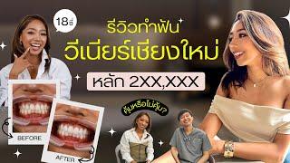 รีวิวทำฟันวีเนียร์ฟันขาว l เหลาฟันเป็นฉลามมั้ย ? lทำไมราคา 200,000++ คลิปนี้มีคำตอบl Milk Nattchanee