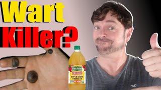 EASY! Remove Warts with Apple Cider Vinegar | 3 Steps! | Chris Gibson