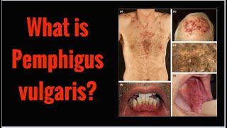 What is PEMPHIGUS VULGARIS? Symptoms, Causes