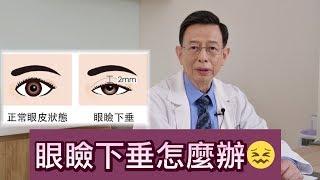 眼瞼下垂怎麼辦？【晶華美醫診所】徐典雄醫師｜台北眼瞼下垂手術 眼瞼下垂手術推薦 眼瞼下垂治療改善