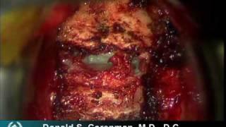 Anterior Cervical Decompression and Fusion (ACDF) | Live Spine Surgery Video | Spine Surgeon