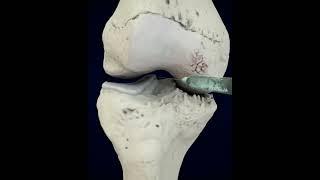 Phương pháp điều trị viêm khớp gối