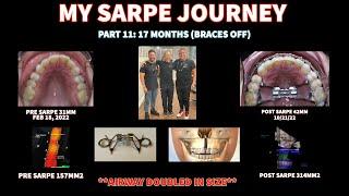 MY SARPE JOURNEY PART 12: 17.5 MONTHS OUT "THE FINALE"