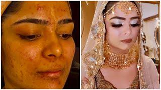 How to correct Acne Skin tutorial | Farah’s beauty salon |