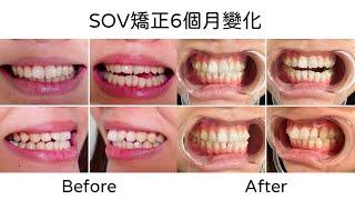 【牙套日記】矯正牙齒會牙齦萎縮？！SOV舒服美6個月隱形矯正變化