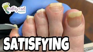 TWO INCH LONG TOENAILS TRIMMED! SO SATISFYING AND SOOTHING TO WATCH!