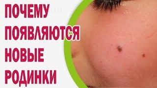 Почему появляются новые родинки на коже