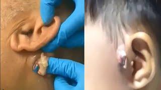 ВЫДАВЛИВАНИЕ ОГРОМНЫХ ПРЫЩЕЙ ЗА УХОМ! ПРЫЩИ/ УГРИ/ Super Pimple Popping Compilation