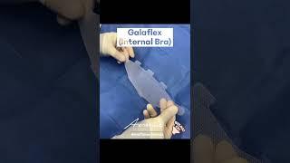 Galaflex Internal Mesh Breast Revision | Avance Plastic Surgery Institute: Dr. Erez Dayan | Reno, NV