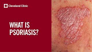 What Is Psoriasis?