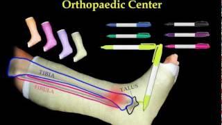 FRACTURED LEG - Everything You Need To Know - Dr. Nabil Ebraheim