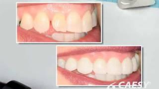 Laminate Veneers - Roseville Dentist