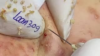 BLACKHEADS REMOVAL (309_1) | Loan Nguyen