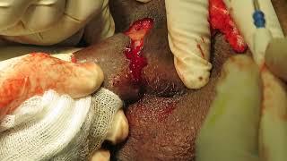 Total penectomy with perineal urethrostomy