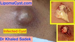 Infected Cyst. Dr Khaled Sadek. LipomaCyst.com